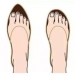 Hallux Valgus—All You Want to Know is Here