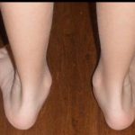 Children Foot Valgus