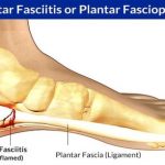 Overweight, Excessive Jogging, Carrying Heavy Objects, Be Careful of “Plantar Fasciitis”
