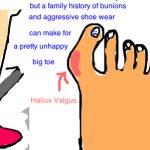 With Hallux Limitus, big toe stiffness is a big deal.