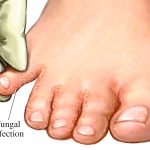 Hong Kong Foot
