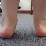 Flat Feet Effect in Children on the Ankle Joints