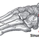 Sinus Tarsi Syndrome: “Ankle Pain”