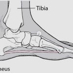 Calcaneal osteoenditis