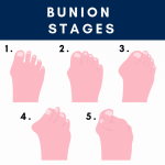 10 Step Guide for Treating Bunion Pain