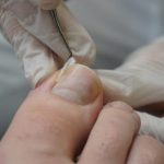 When an Ingrown Toenail Requires Help from Your Podiatrist