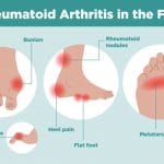 Arthritis Foot