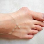 Bunions