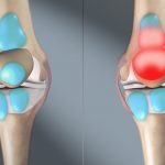 Foot Bursitis