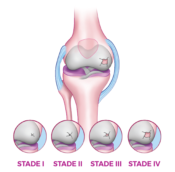 Osteoarthritis of the Knee