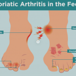 Psoriasis feet