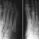 How Orthotics Can Help with Foot Stress Fractures