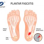 “Insole” wrong is actually the culprit of foot disease? Orthopedic surgeons teach you the correct choice of “soles”