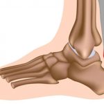 Heel Inserts for Achilles Tendonitis