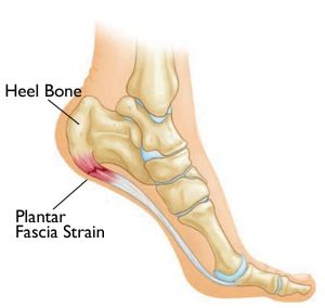 Heel inserts for plantar fasciitis