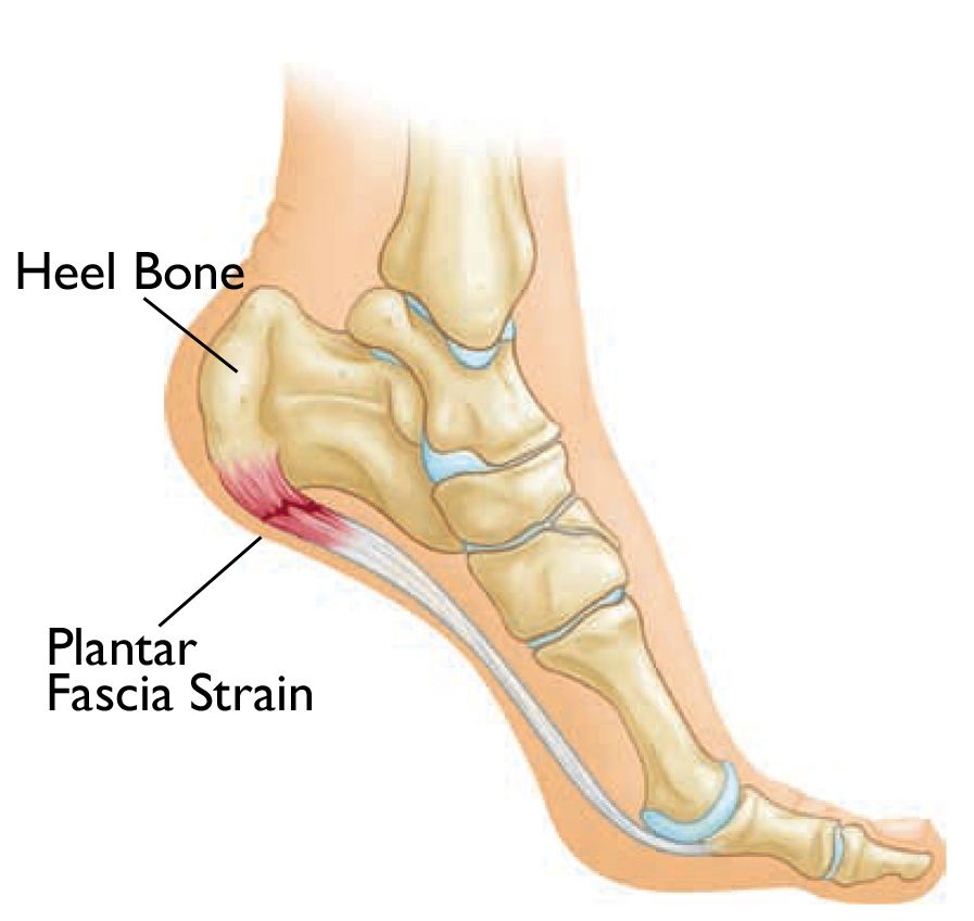 Heel inserts for plantar fasciitis