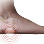 a lateral heel wedge for medial knee pain