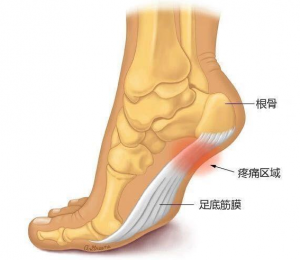 ortopediset kenkäsisäkkeet kantapään kipuihin