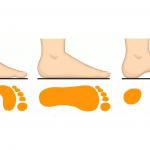 The best age for correction of Flat feet
