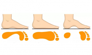The best age for correction of Flat feet
