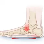 the effects of flat feet