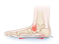 hazards of Flat feet