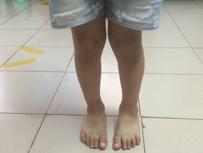 Correcting Children's Bowlegs