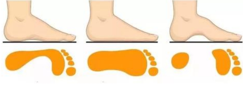 Children's flat feet