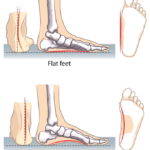 Do Orthotic Insoles Really Work for Flat Feet?