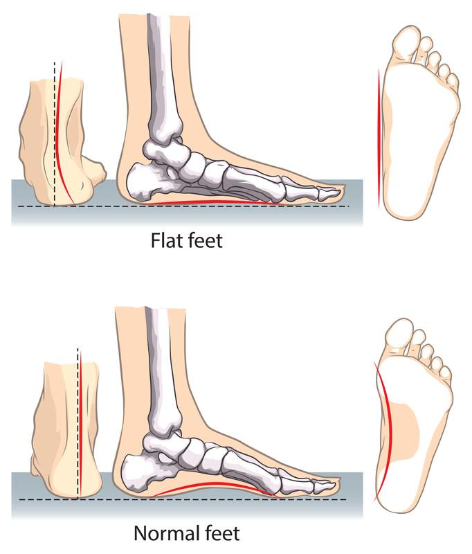 Do Orthotic Insoles Really Work for Flat Feet?