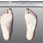 Rehabilitation Protocols for Flat Feet Using Custom Orthotics