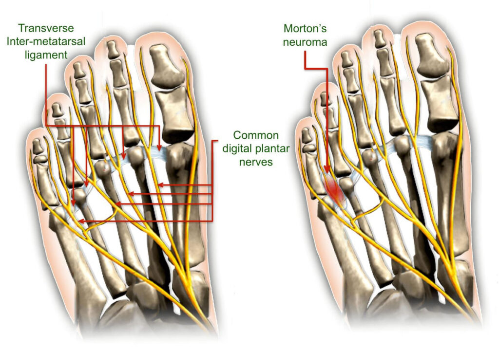 Do orthotics help Morton's neuroma?