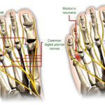 Do orthotics help Morton’s neuroma?