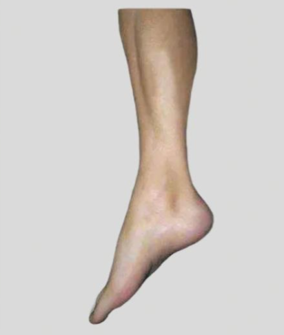 Can insoles help with overpronation?