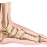 Best Insoles for High Arch and Metatarsal Pad: How to Choose the Right Support