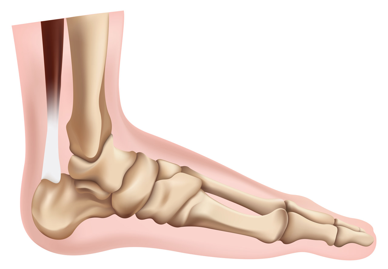 Best Insoles for High Arch and Metatarsal Pad: How to Choose the Right Support