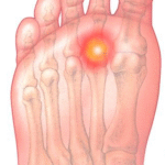 Best Insoles for Balls of Feet: How Orthotic Insoles Improve Forefoot Comfort