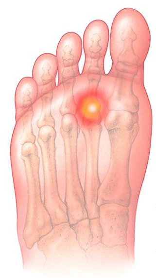 Metatarsal Pain