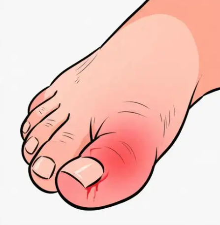 Big Toe Arthritis